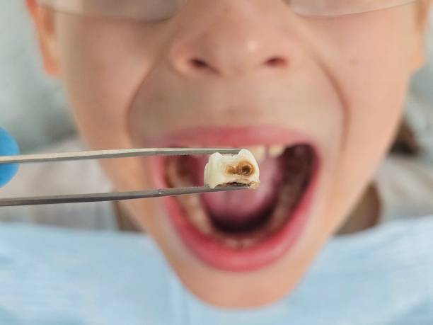 Best Broken or Chipped Tooth Repair in Burt, MI