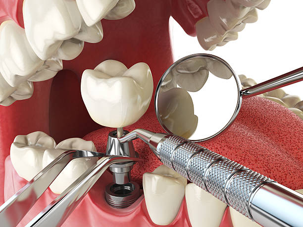 Best Emergency Dental Care for Sports Injuries in Burt, MI